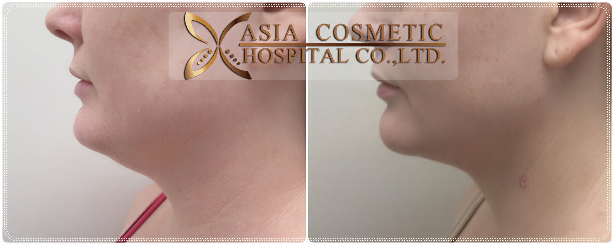 نتائج شفط دهون الذقن قبل وبعد في Asia Cosmetic Hospital، تحديد الفك المحسن
