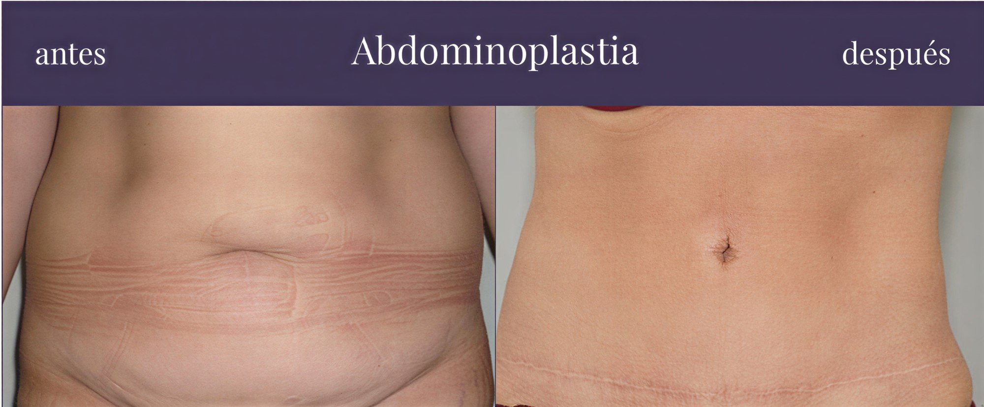 Resultados de abdominoplastia antes y después en Centro Médico Teknon, abdomen mejorado