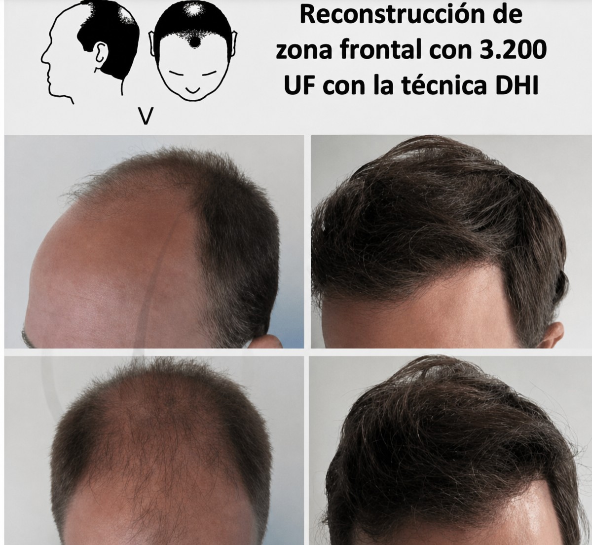 نتائج زراعة الشعر بتقنية DHI قبل وبعد في Centro Médico Teknon، استعادة خط الشعر الأمامي
