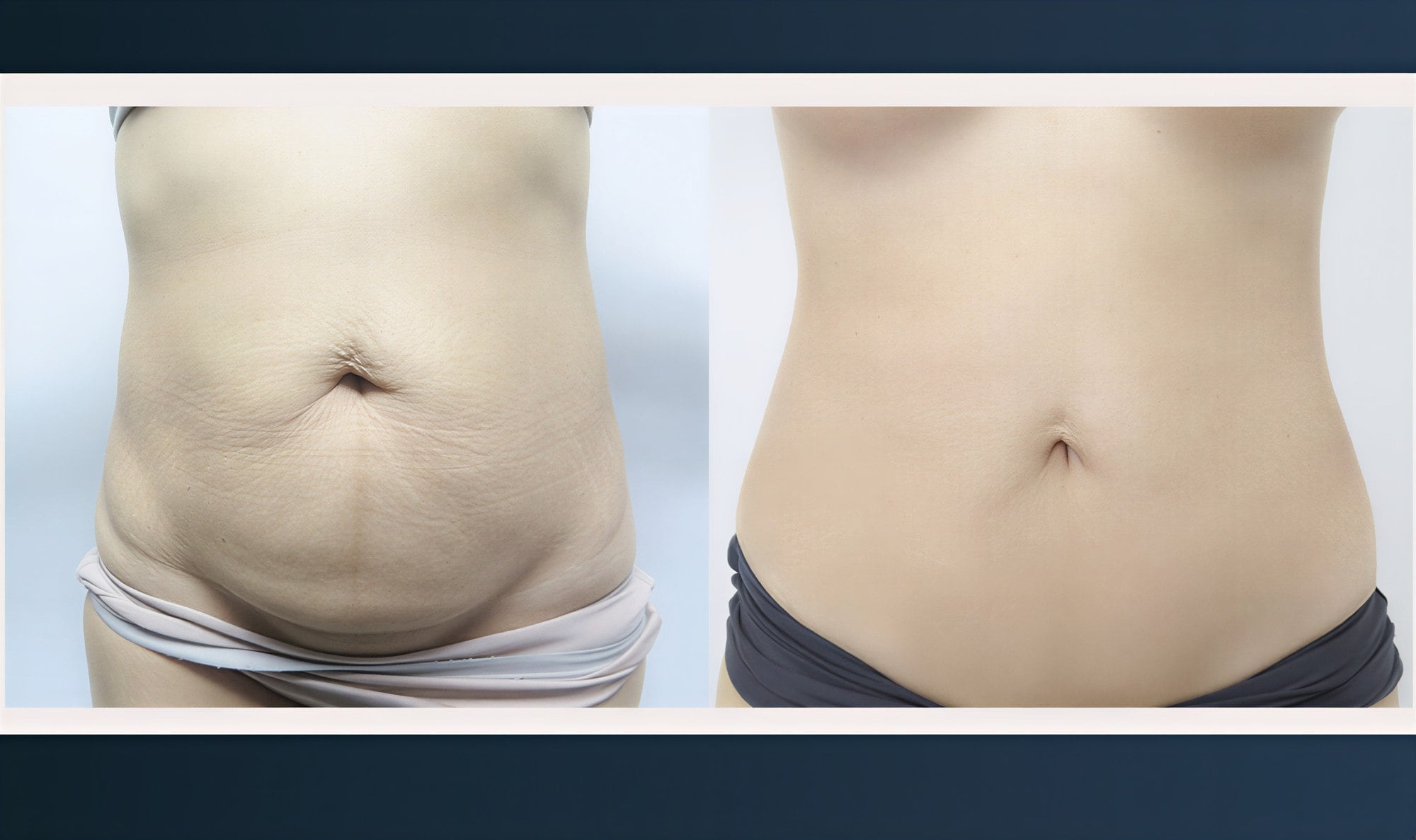 Resultados de abdominoplastia antes y después en Asia Cosmetic Hospital, mejora abdominal visible