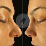 Resultados de rinoplastia antes y después en Atlas University Hospital, mejora de la nariz