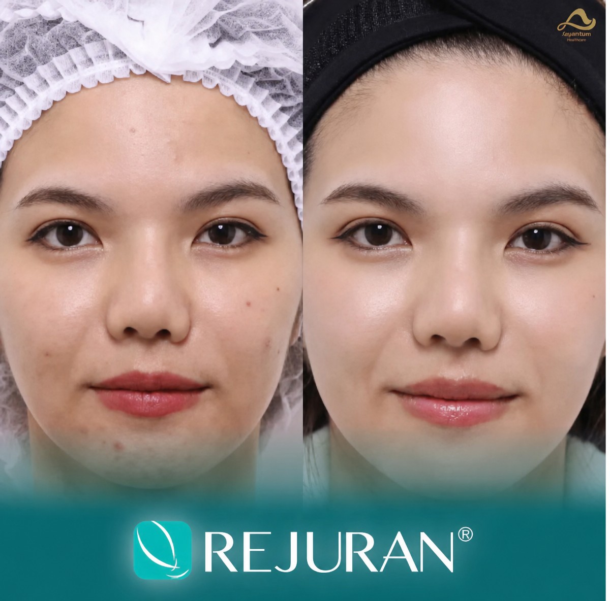 نتائج قبل وبعد علاج Skinbooster في عيادة Anjali – بشرة وجه أكثر نعومة ونقاء