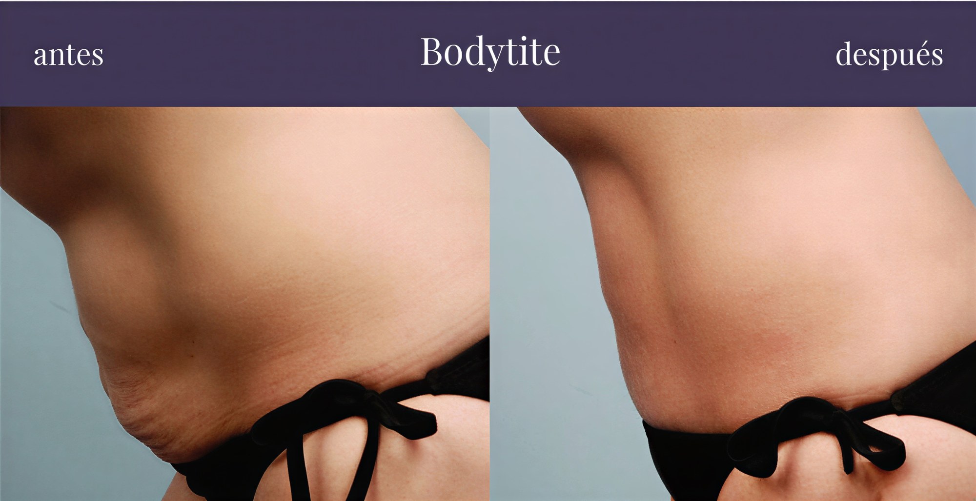 نتائج BodyTite قبل وبعد في Centro Médico Teknon – تحسين شكل البطن