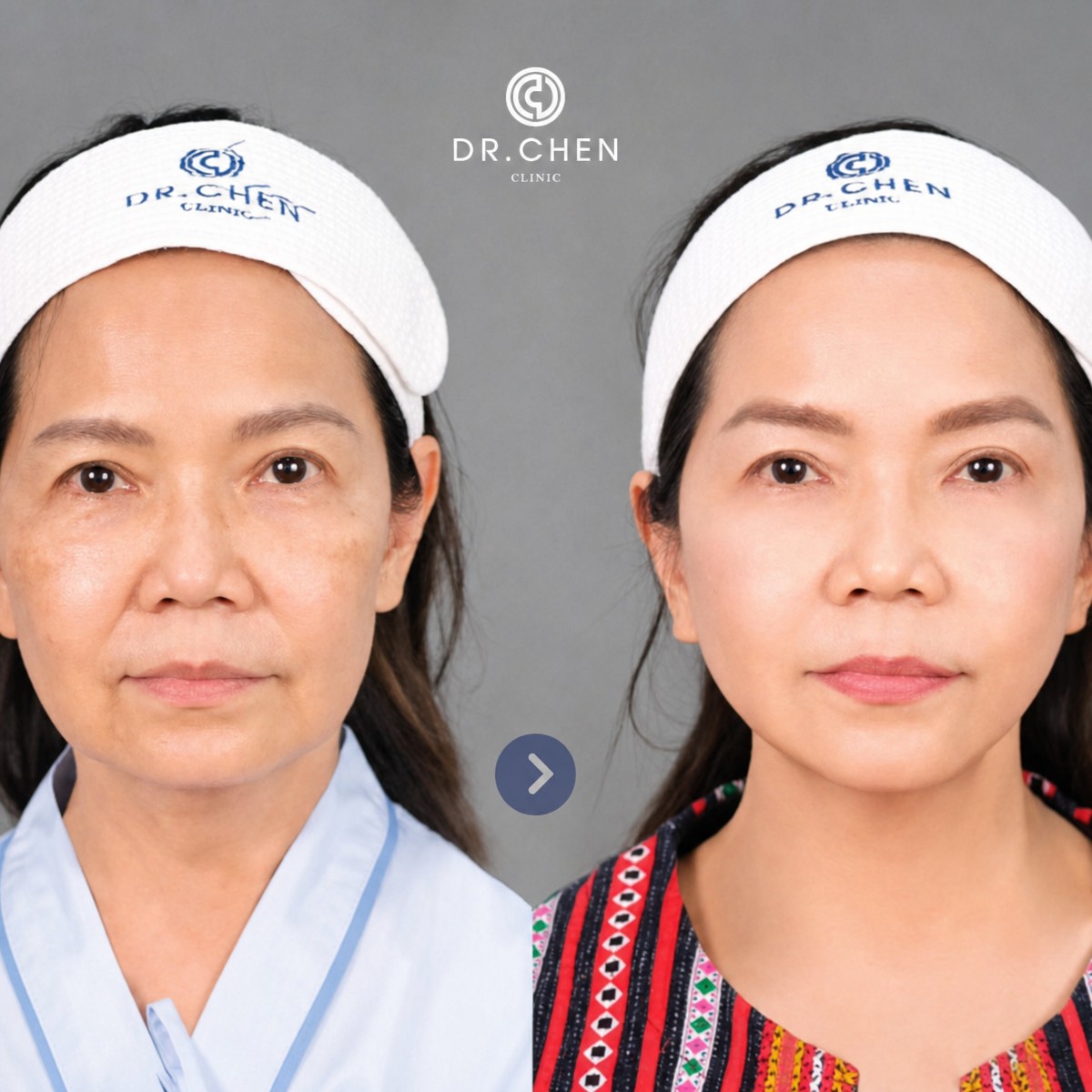 نتيجة شد الوجه العميق قبل وبعد في مركز Dr. Chen Surgery Hospital International Center