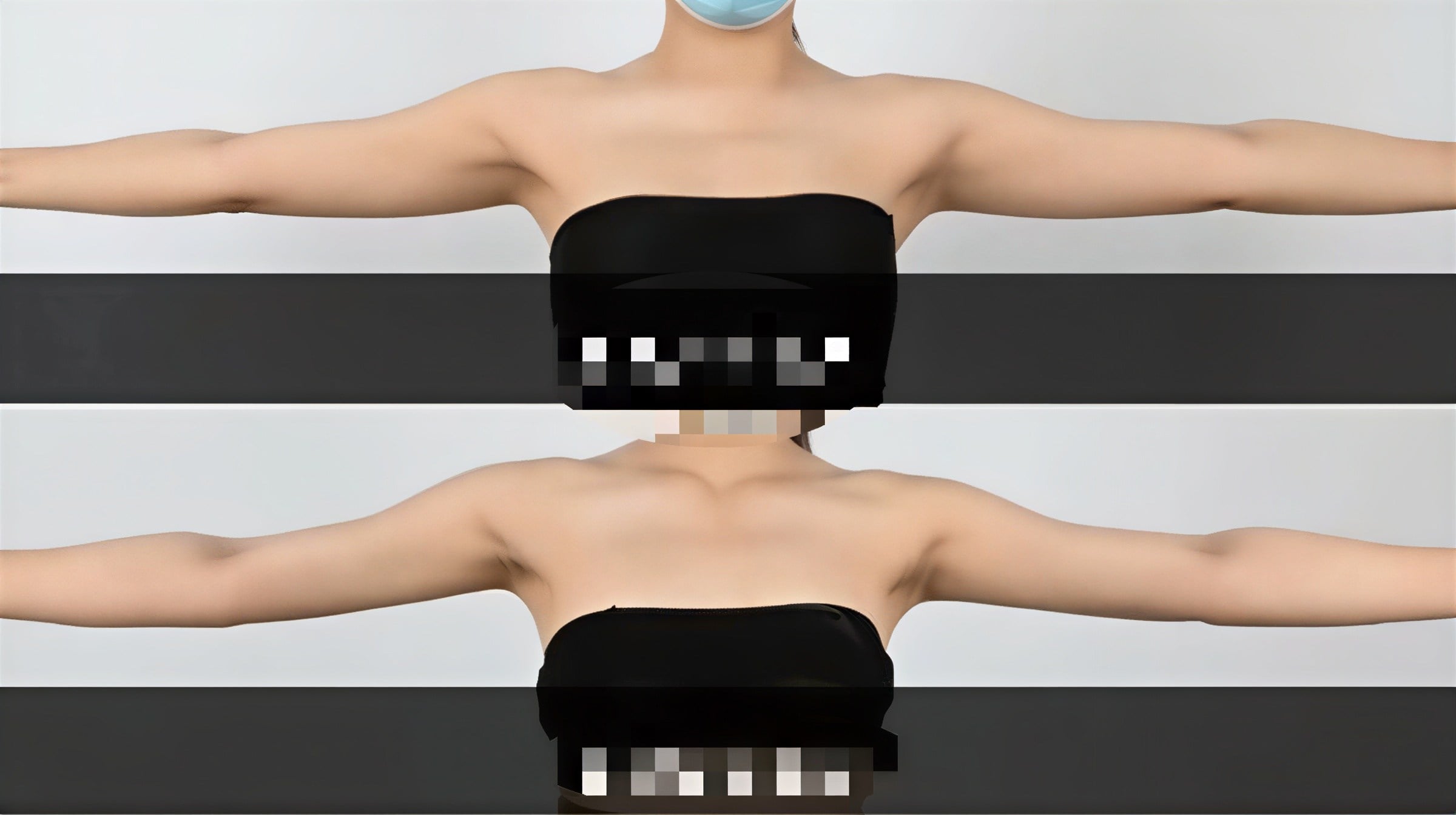 Resultados de liposucción de brazos antes y después en Dr. Chen Surgery Hospital International Center