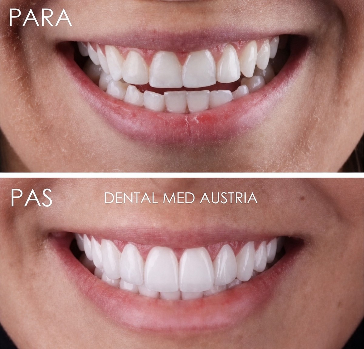 نتائج قبل وبعد تركيب تيجان الزركونيا في Dental Med Austria & Elixence، تحول الابتسامة