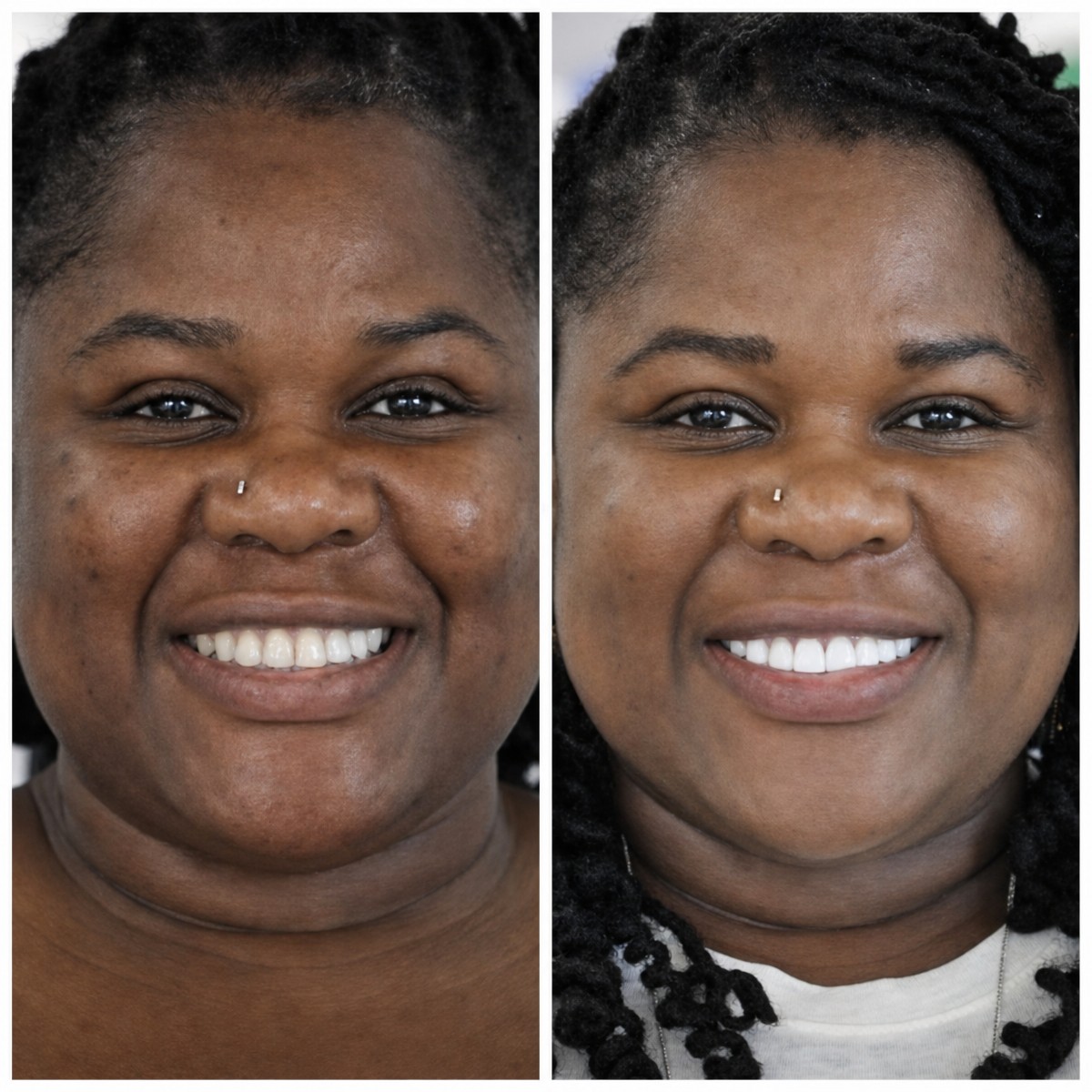Resultados antes y después de coronas de zirconia en DentaPoint Dental Clinics, sonrisa renovada