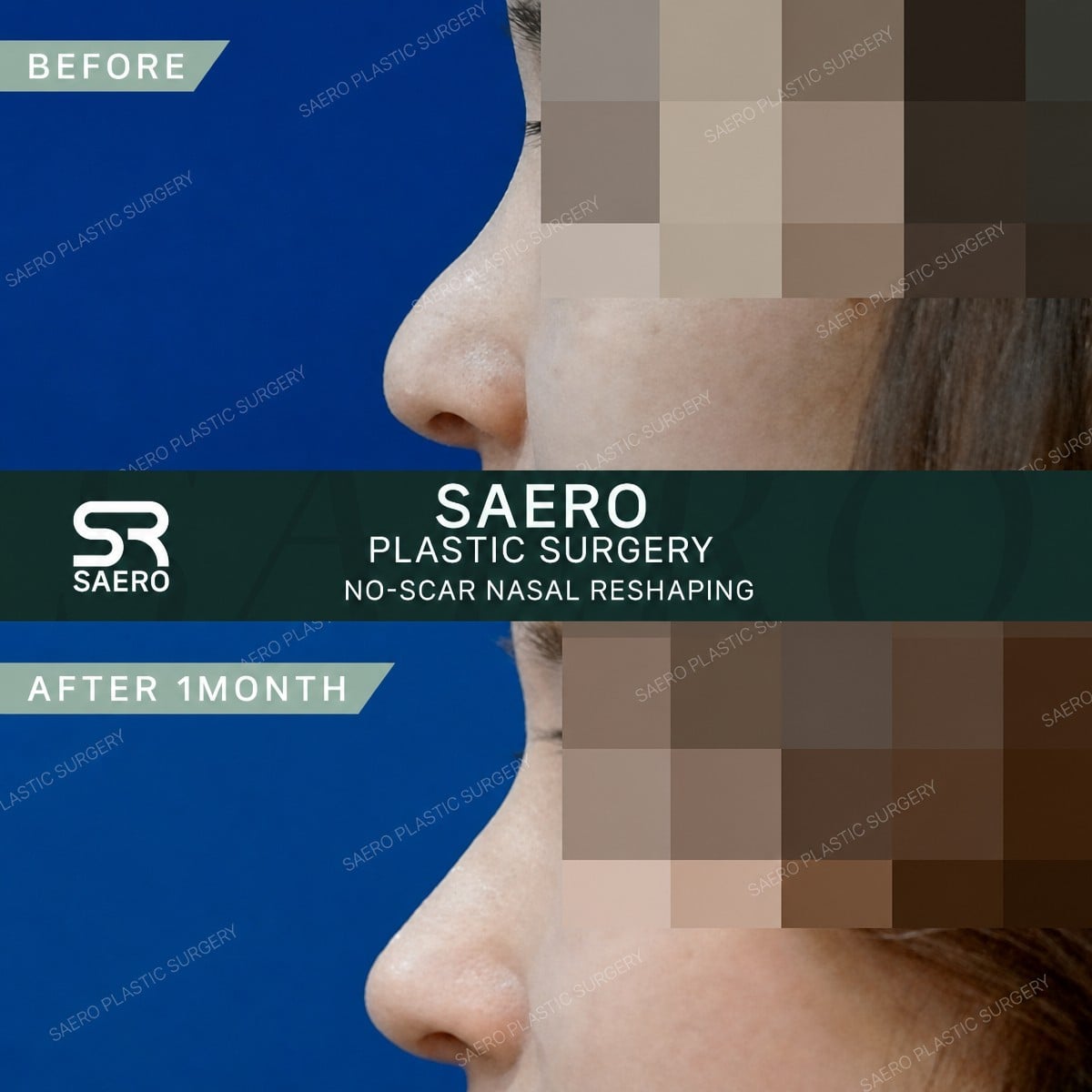 نتائج قبل وبعد عملية تجميل الأنف التصحيحية في SAERO Plastic Surgery، إعادة تشكيل الأنف