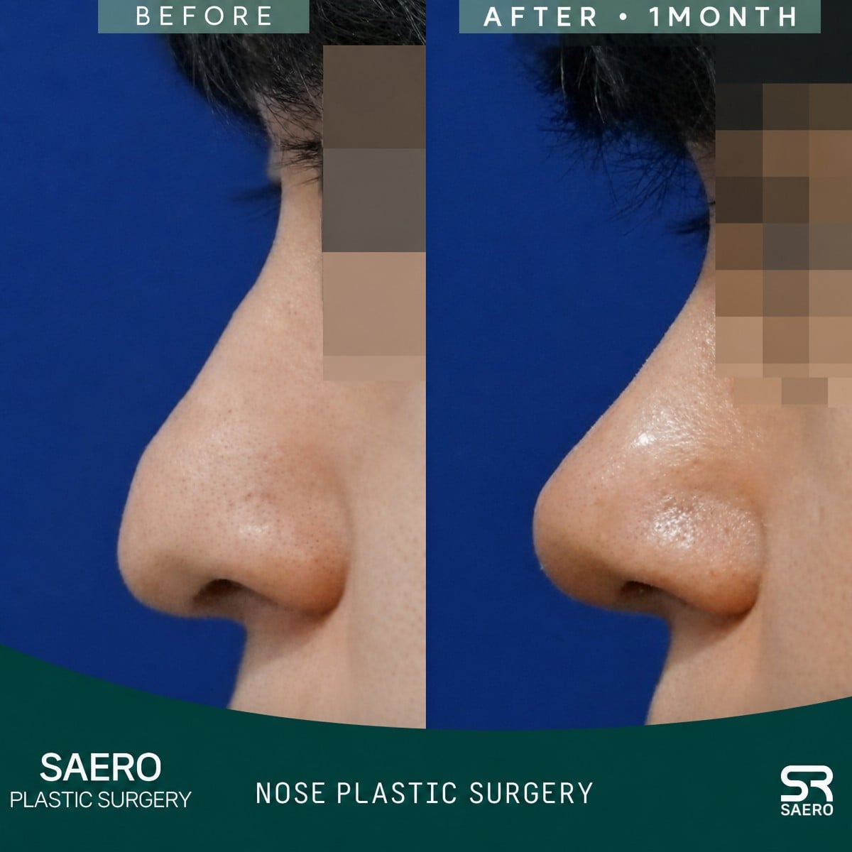Resultado antes y después de rinoplastia secundaria en SAERO Plastic Surgery, contorno mejorado