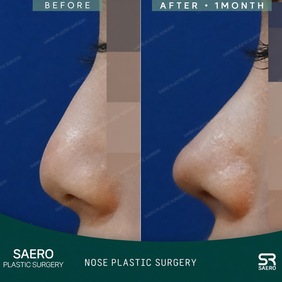 نتيجة قبل وبعد تجميل الأنف التصحيحي في SAERO Plastic Surgery، تحسين شكل الأنف
