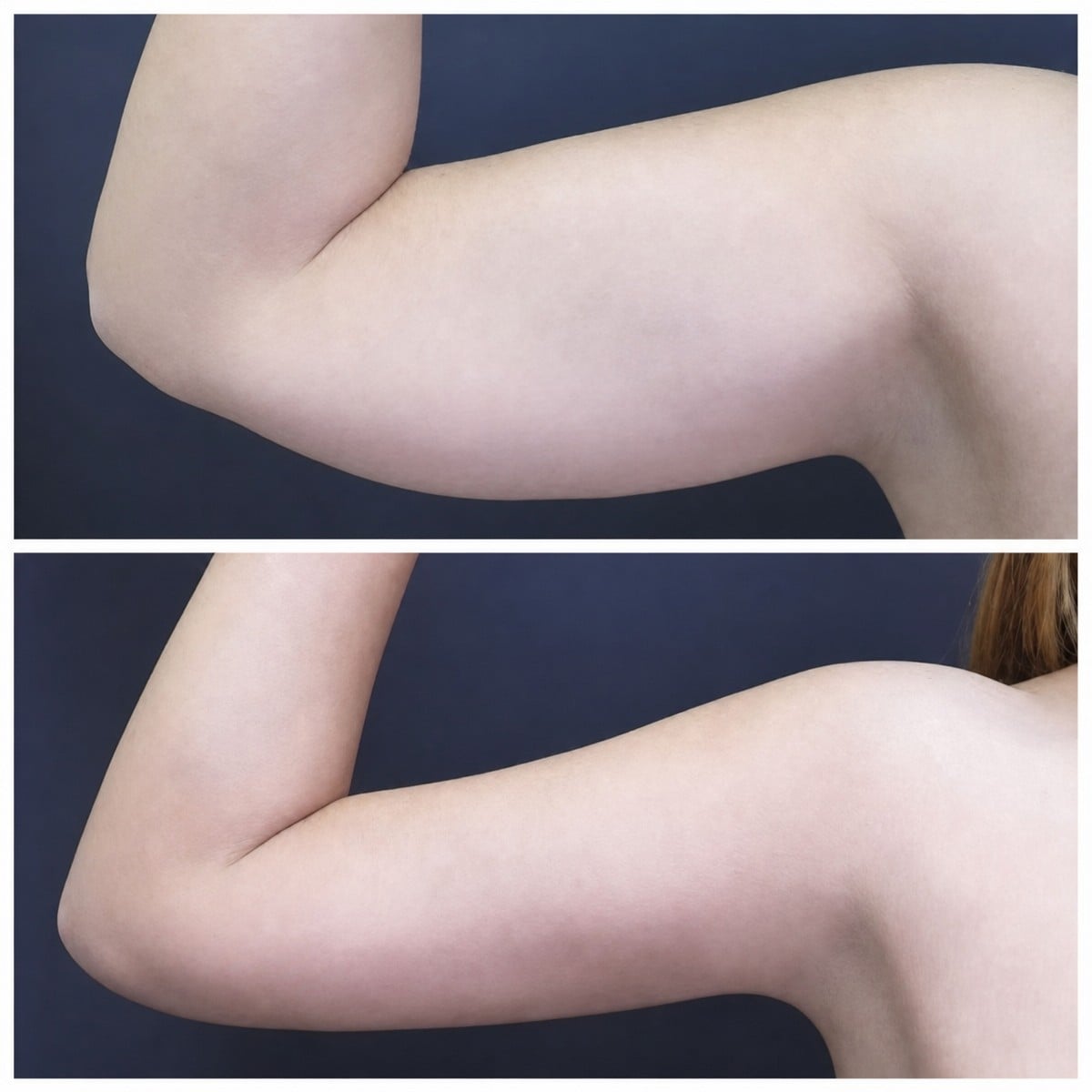 Resultados de liposucción de brazo superior antes y después en Asia Cosmetic Hospital, brazo más delgado