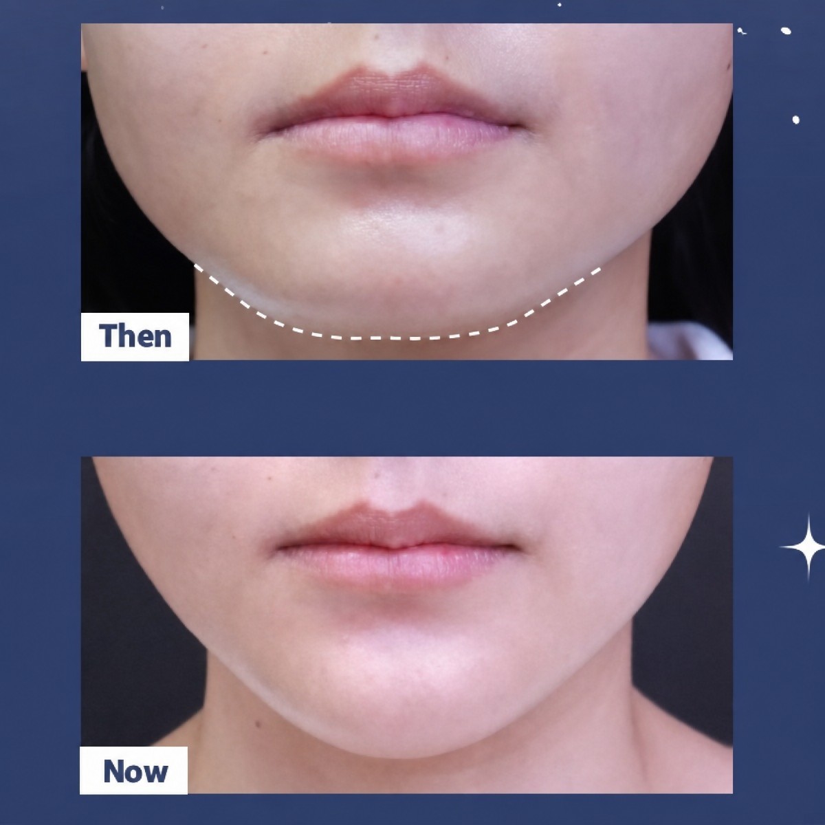 نتائج قبل وبعد زراعة الذقن في Asia Cosmetic Hospital، تحسين شكل الذقن