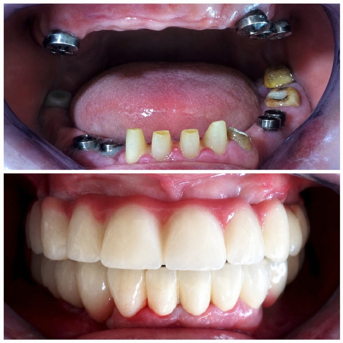Resultados antes y después de implante dental con corona en Hospitadent Dental Group - Estambul Mecidiyeköy