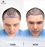 Resultados de trasplante capilar antes y después en Dr. Chen Clinic, restauración capilar