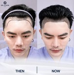 Resultados de trasplante capilar antes y después en Dr. Chen Clinic, restauración capilar