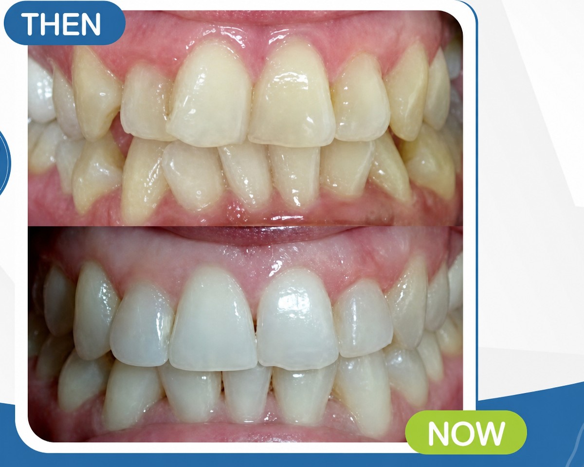 Resultados antes y después de brackets Damon en Deezy Dental Home – alineación dental mejorada
