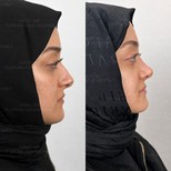 نتائج عملية تجميل الأنف قبل وبعد في عيادة البروفيسور فوركان كارابكمز للجراحة التجميلية