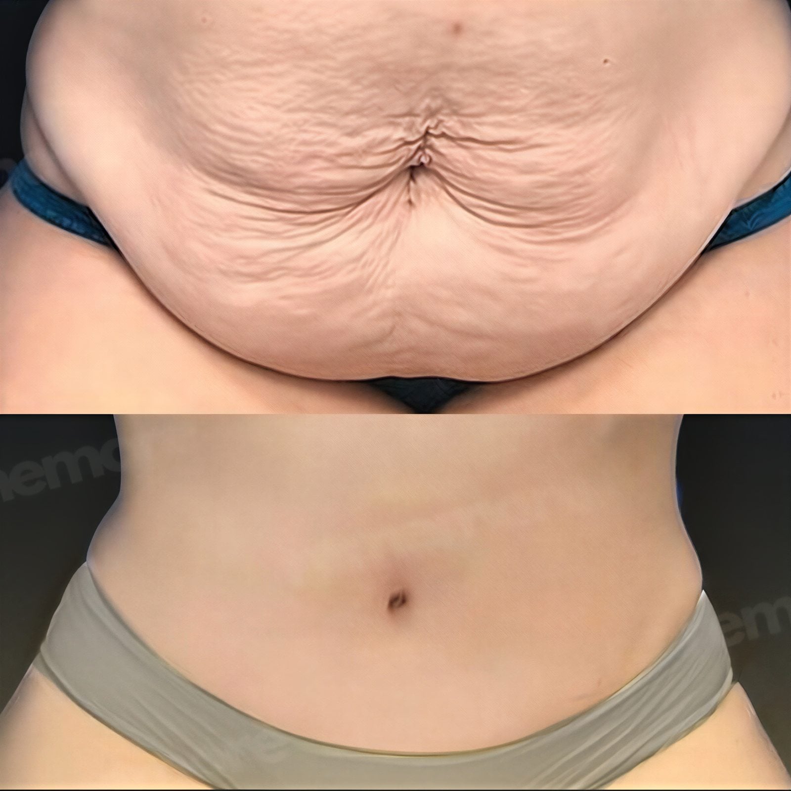 Resultados de abdominoplastia y liposucción antes y después en Memorial Şişli Hospital, abdomen plano