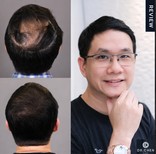 Resultados de trasplante capilar en Dr. Chen Clinic: densidad capilar restaurada en hombre