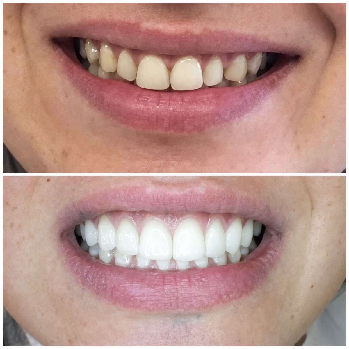 Antes y después de coronas de zirconia en TWT Health Clinic, resultado de sonrisa