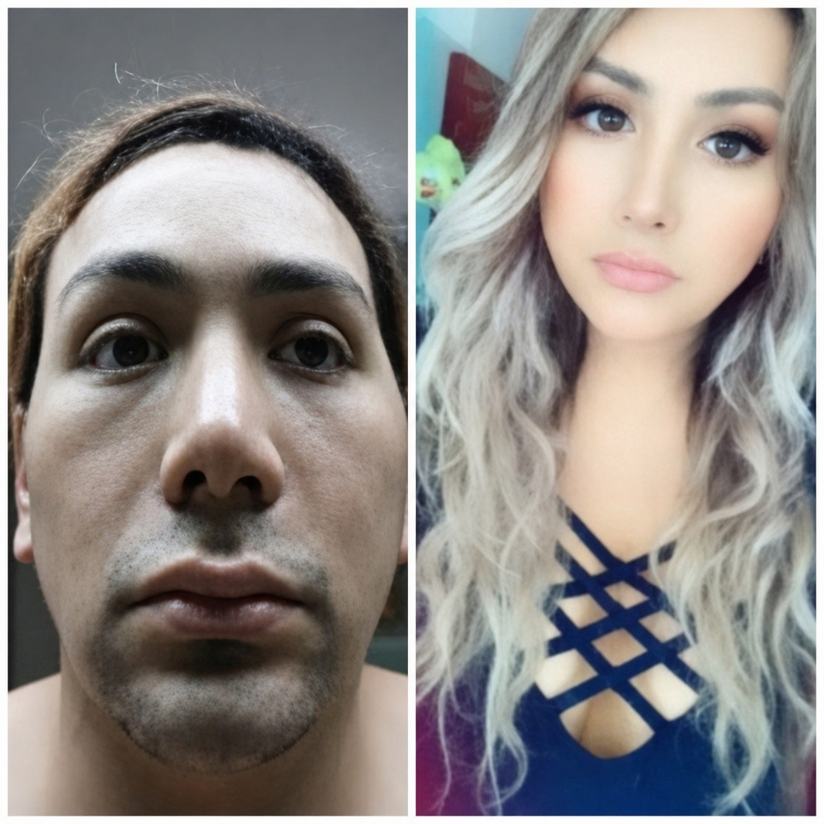 نتائج قبل وبعد جراحة تغيير الجنس في Bangkok Plastic Surgery، تأنيث الوجه