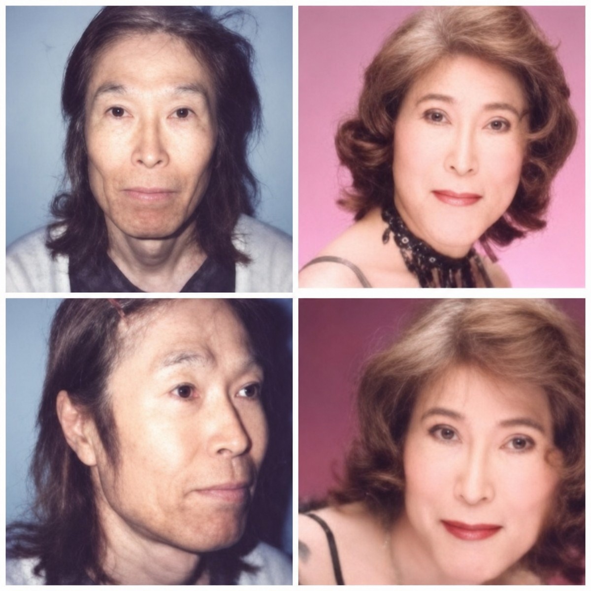 نتائج قبل وبعد جراحة تغيير الجنس في Bangkok Plastic Surgery، تأنيث الوجه