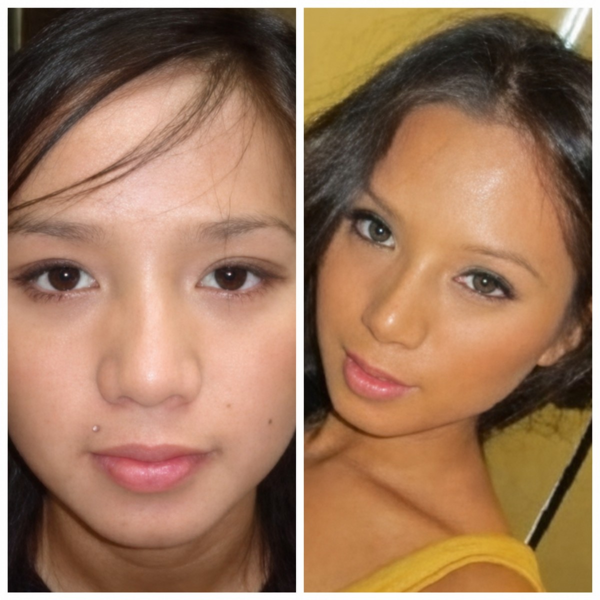 Resultados de rinoplastia antes y después en Bangkok Plastic Surgery, mejora de la nariz