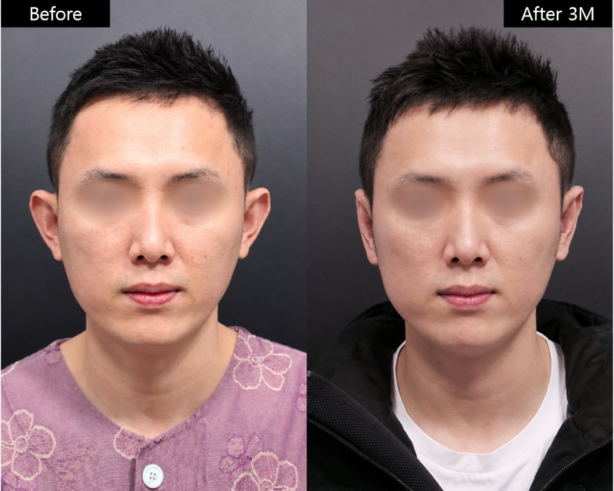 نتائج تجميل الأذن قبل وبعد في VG Plastic Surgery، تحسين شكل وأذن متناسقة