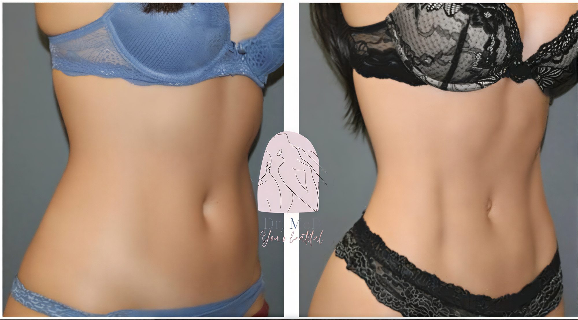 Resultados de liposucción abdominal antes y después en Dr. MED, mejora visible de la cintura