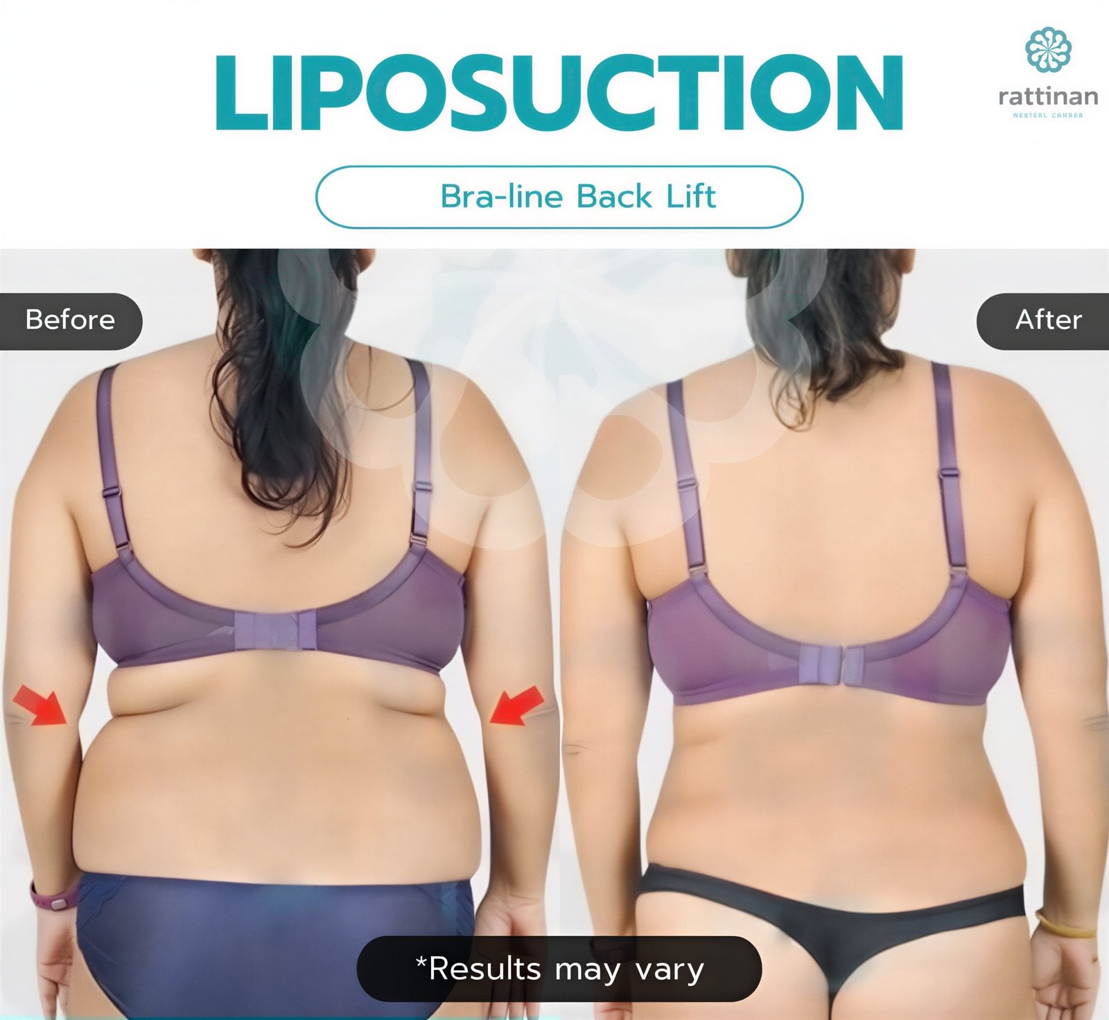 Resultados de liposucción de espalda antes y después en Rattinan Clinic, contorno mejorado