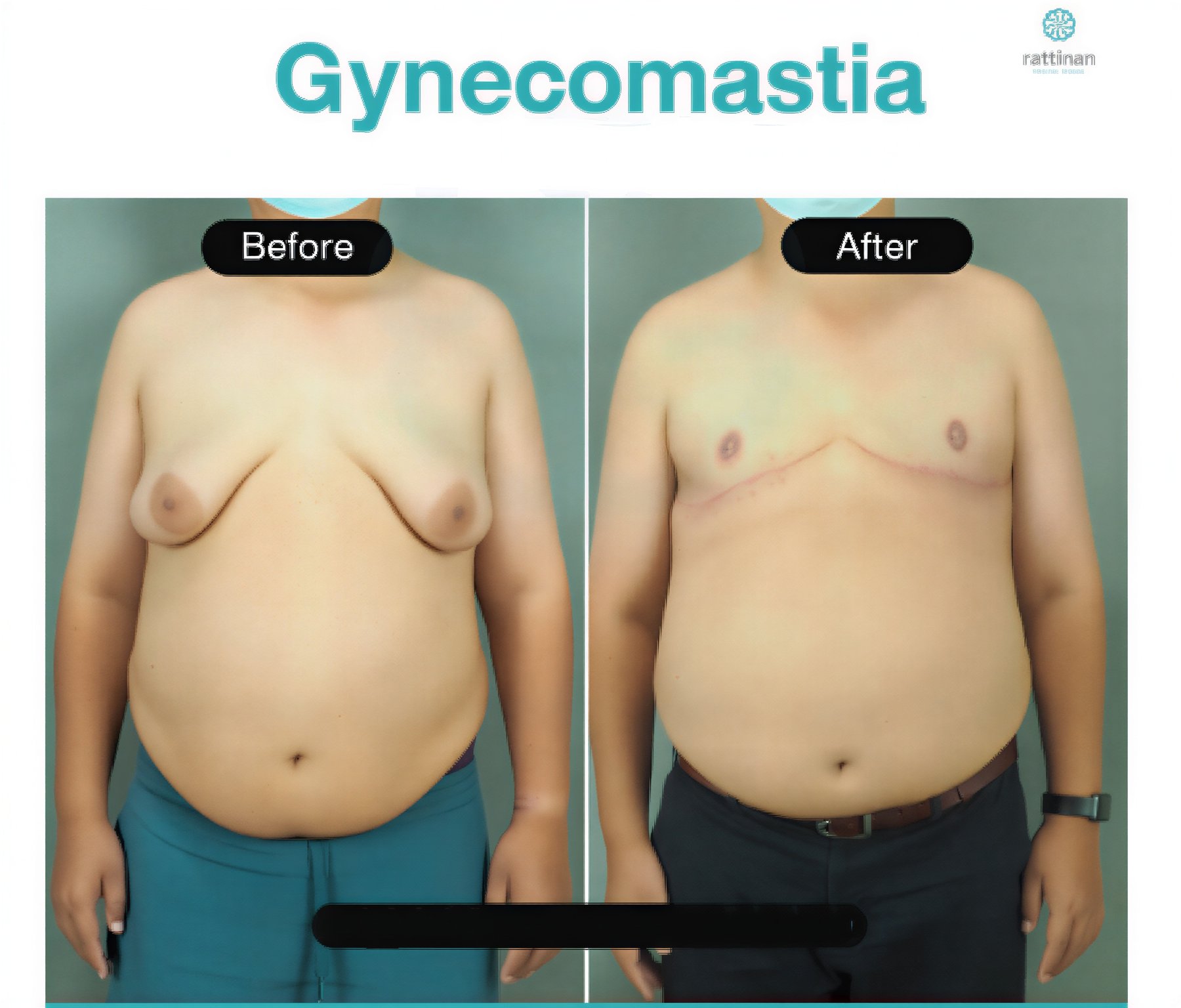 Resultados antes y después de cirugía de ginecomastia en Rattinan Clinic, contorno masculino
