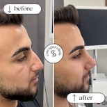 نتيجة عملية تجميل الأنف قبل وبعد في عيادة Estexper، تحسين شكل الأنف لرجل