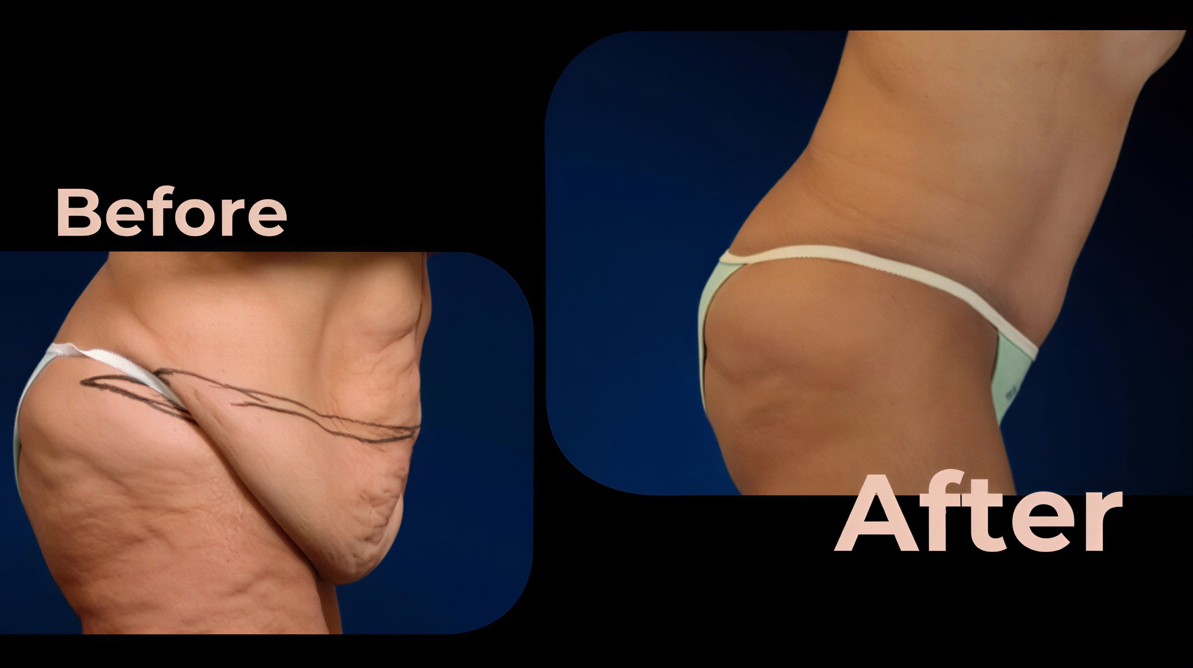 Resultados de abdominoplastia y liposucción antes y después en Avicenna International Hospital