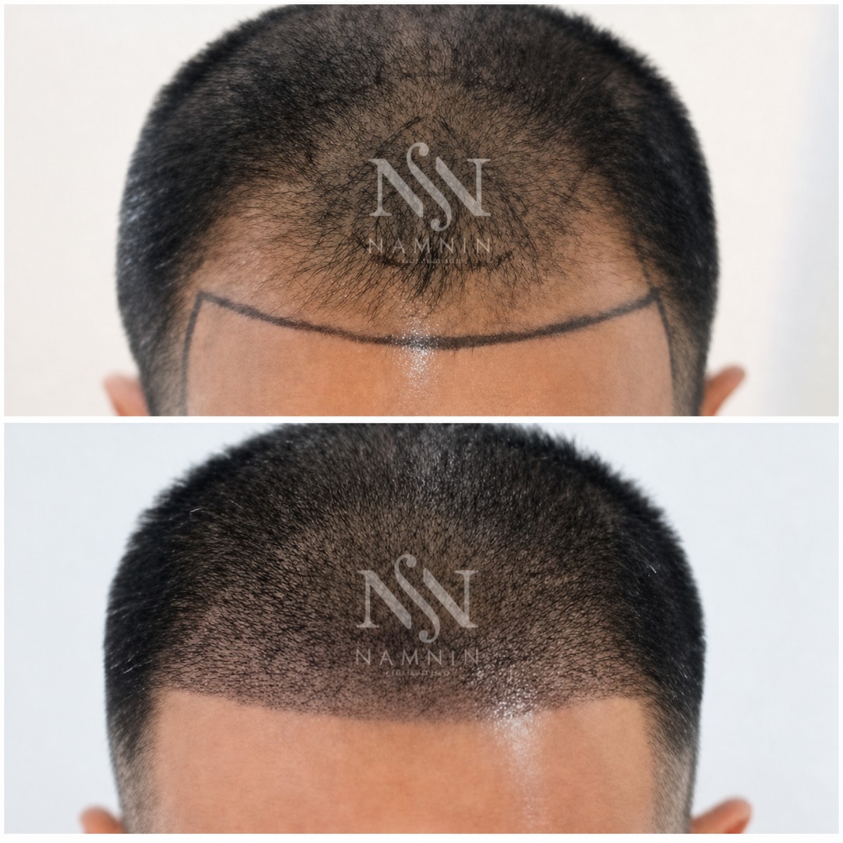 نتائج زراعة الشعر FUE قبل وبعد في عيادة Namninforv، كثافة خط الشعر المحسنة