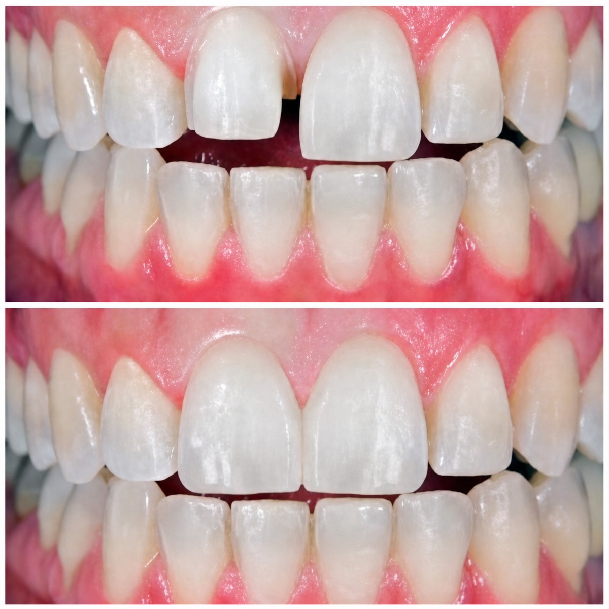 نتائج قبل وبعد الفينير في Love Dental and Sthetic Clinic – تحسين جمالية الابتسامة