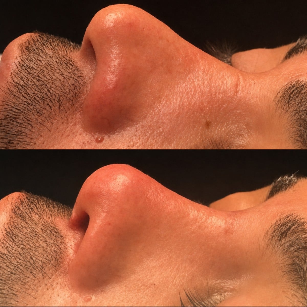 نتائج تجميل الحاجز الأنفي قبل وبعد في مستشفى ميموريال شيشلي، تحسين شكل الأنف