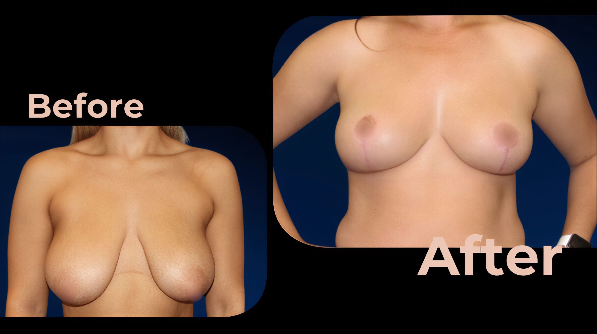 Resultados de mamoplastia antes y después en Avicenna International Hospital, levantamiento de senos