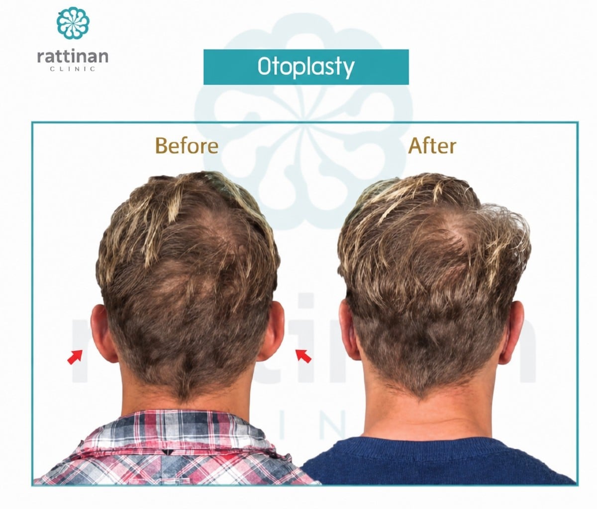 Resultados de otoplastia antes y después en Rattinan Clinic, corrección de orejas