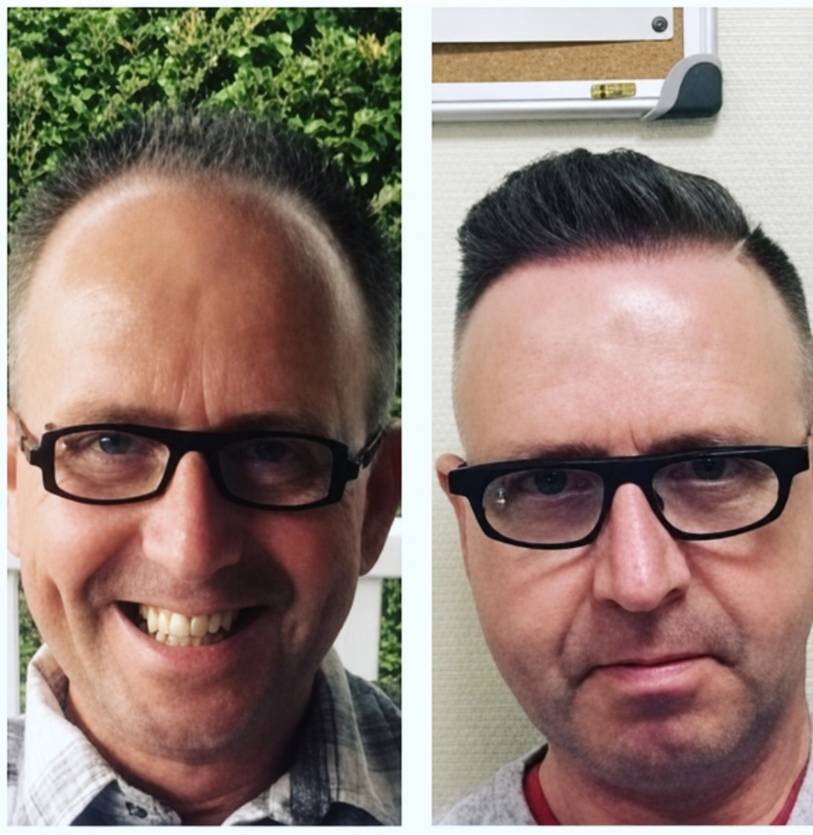 Resultados antes y después de trasplante capilar DHI en Istanbul Aesthetic Plastic Surgery Center