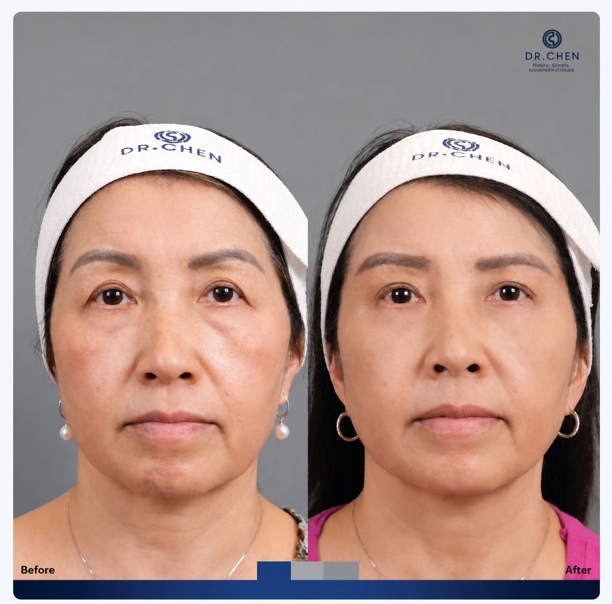 نتائج رأب الجفن السفلي قبل وبعد في Dr. Chen Surgery Hospital International Center