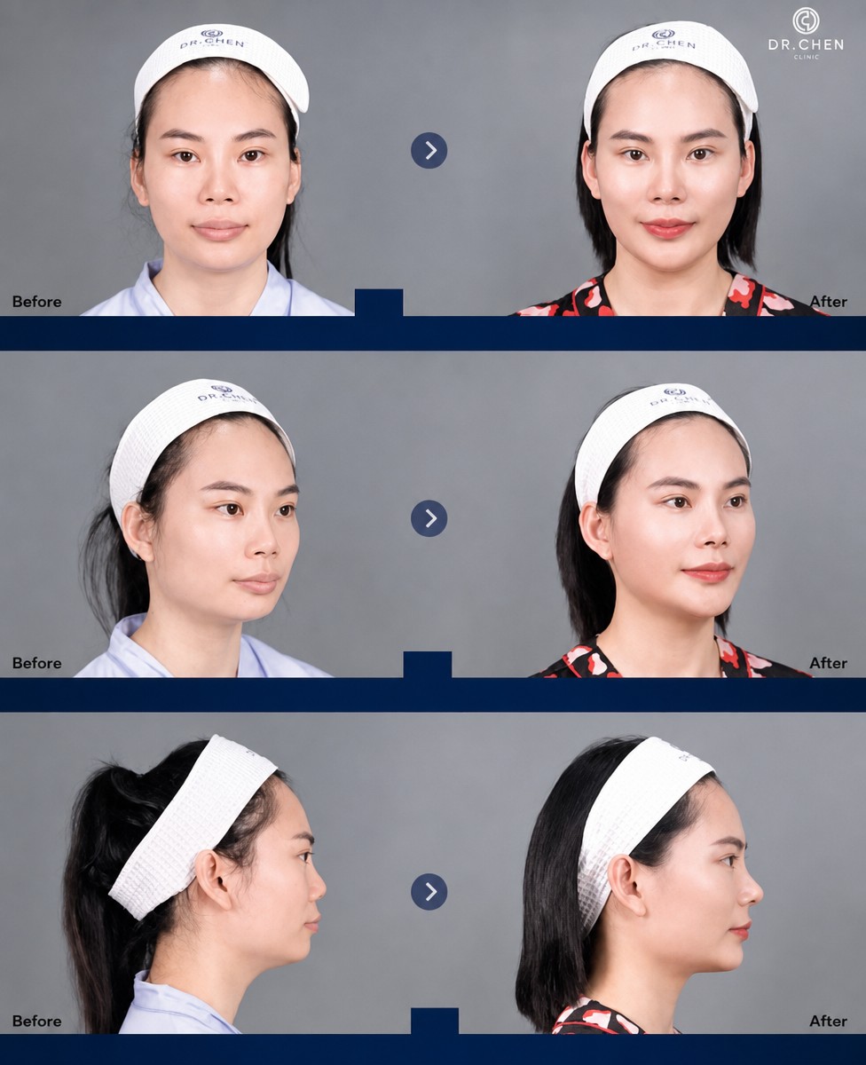 Resultados antes y después de implante de mentón en Dr. Chen Surgery Hospital International Center, contorno facial