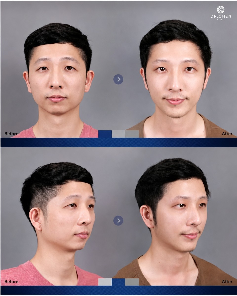 Resultados antes y después de implante de mentón en Dr. Chen Surgery Hospital International Center