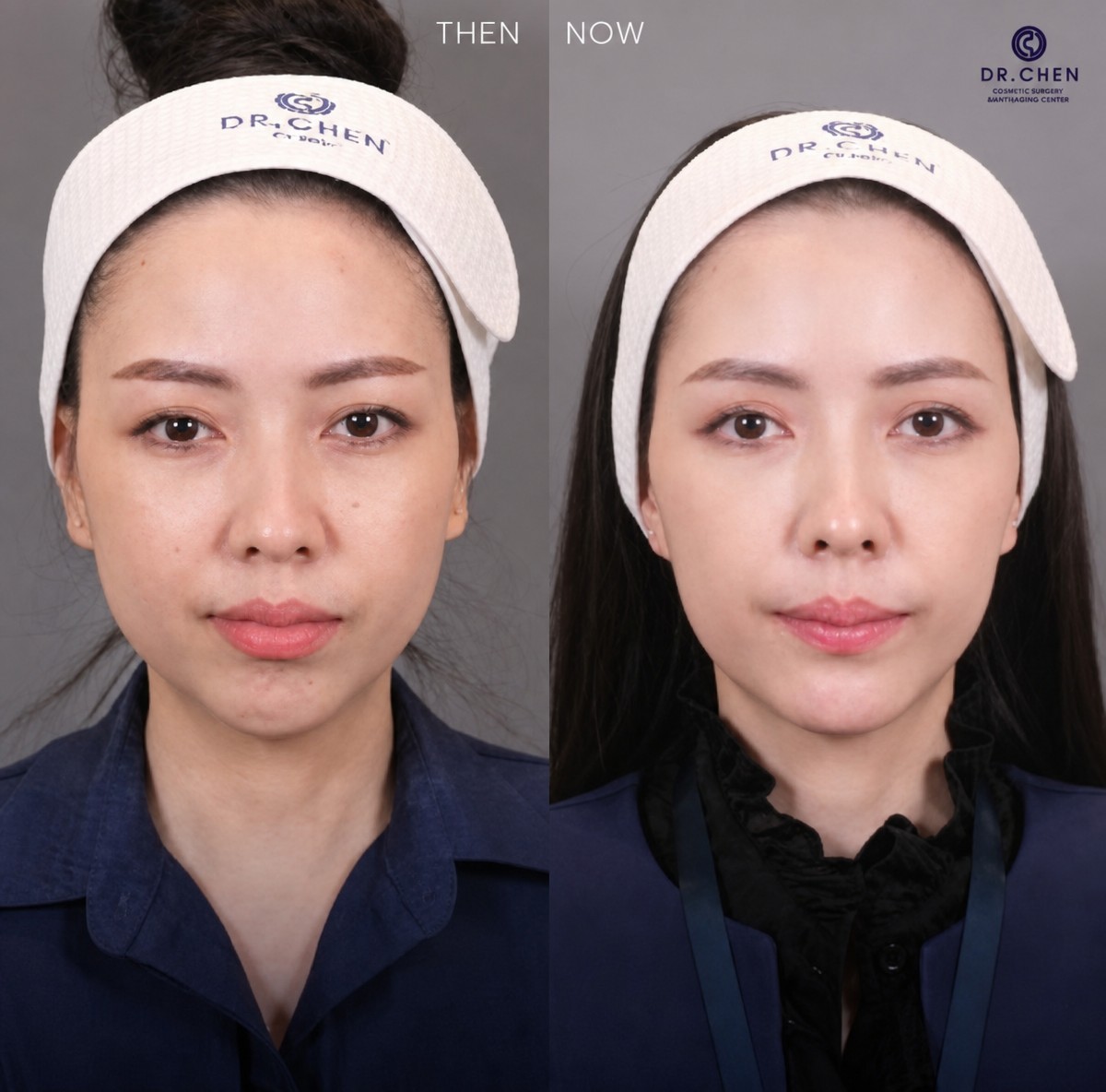 Resultados antes y después de implante de mentón en Dr. Chen Surgery Hospital International Center