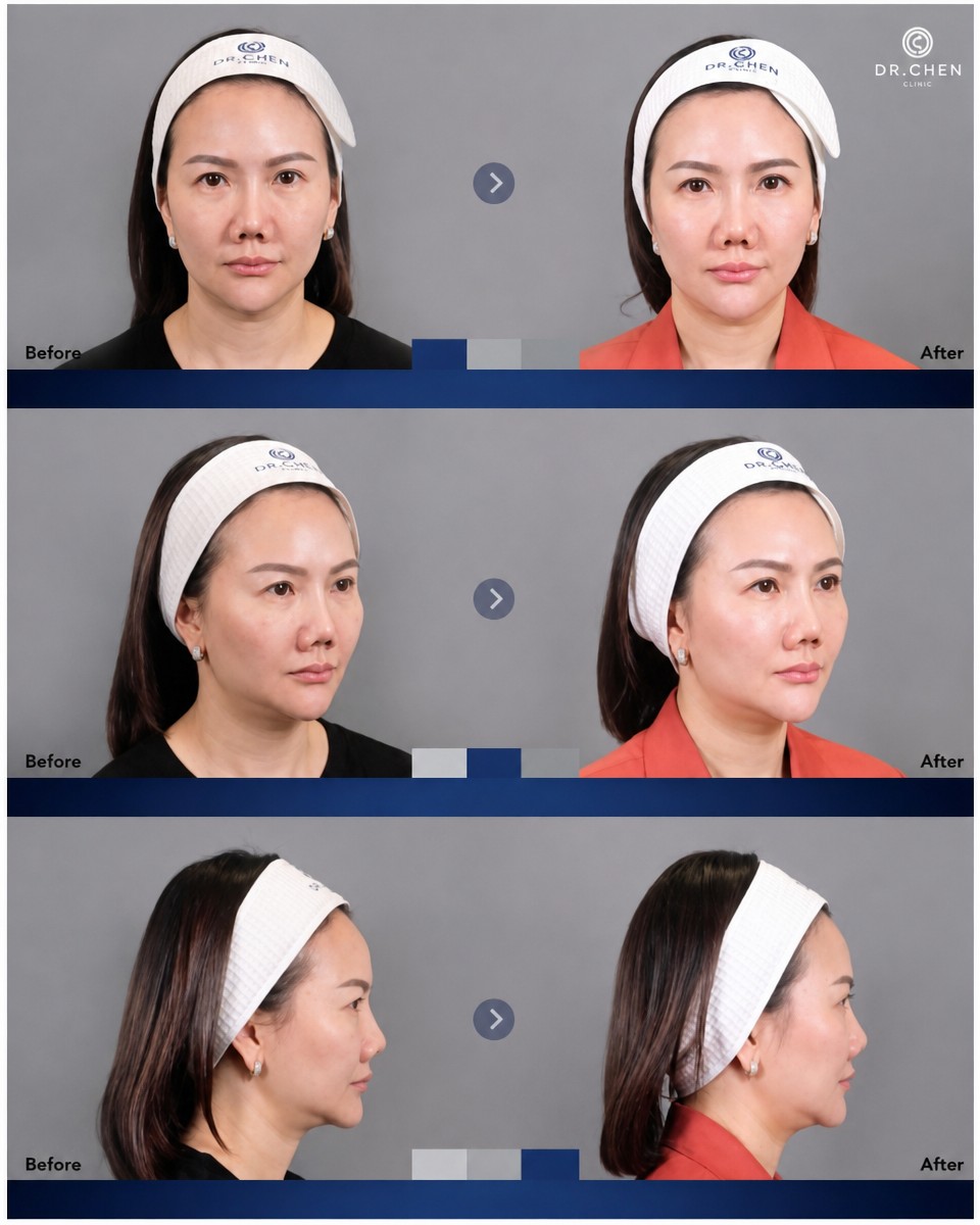 نتائج قبل وبعد حقن الفيلر في Dr. Chen Surgery Hospital International Center، تحسين ملامح الوجه