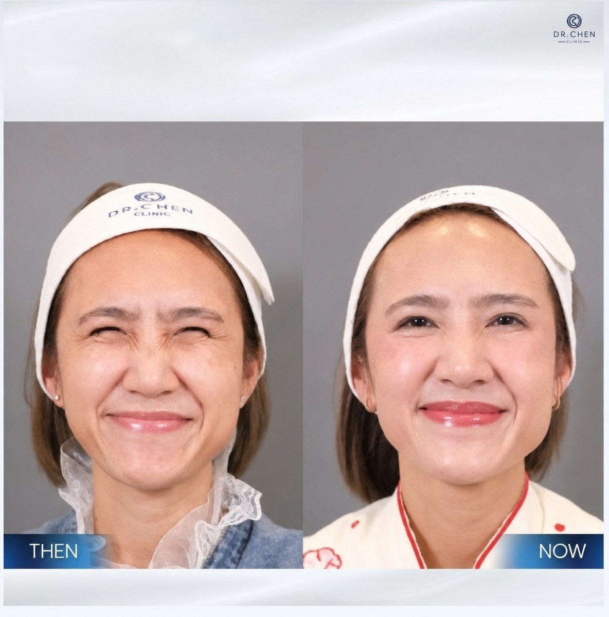 نتائج قبل وبعد حقن البوتوكس في عيادة Dr. Chen، تقليل تجاعيد الوجه