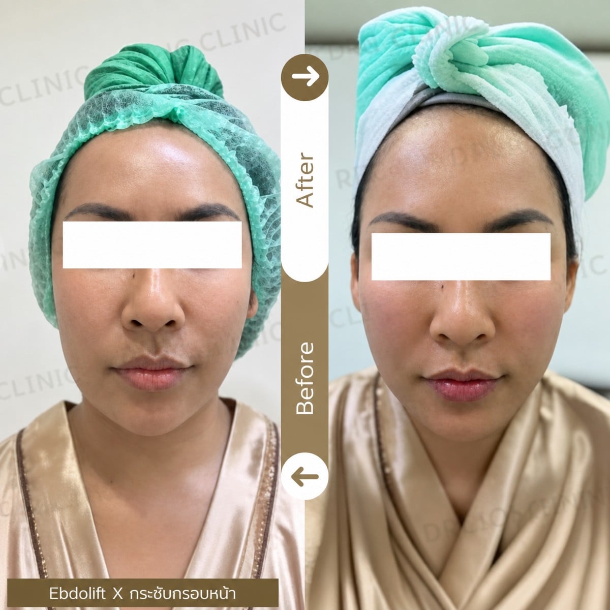 نتيجة شد الوجه بالخيوط قبل وبعد في Doctor Aomthong Clinic - Center For Women، تحديد الوجه