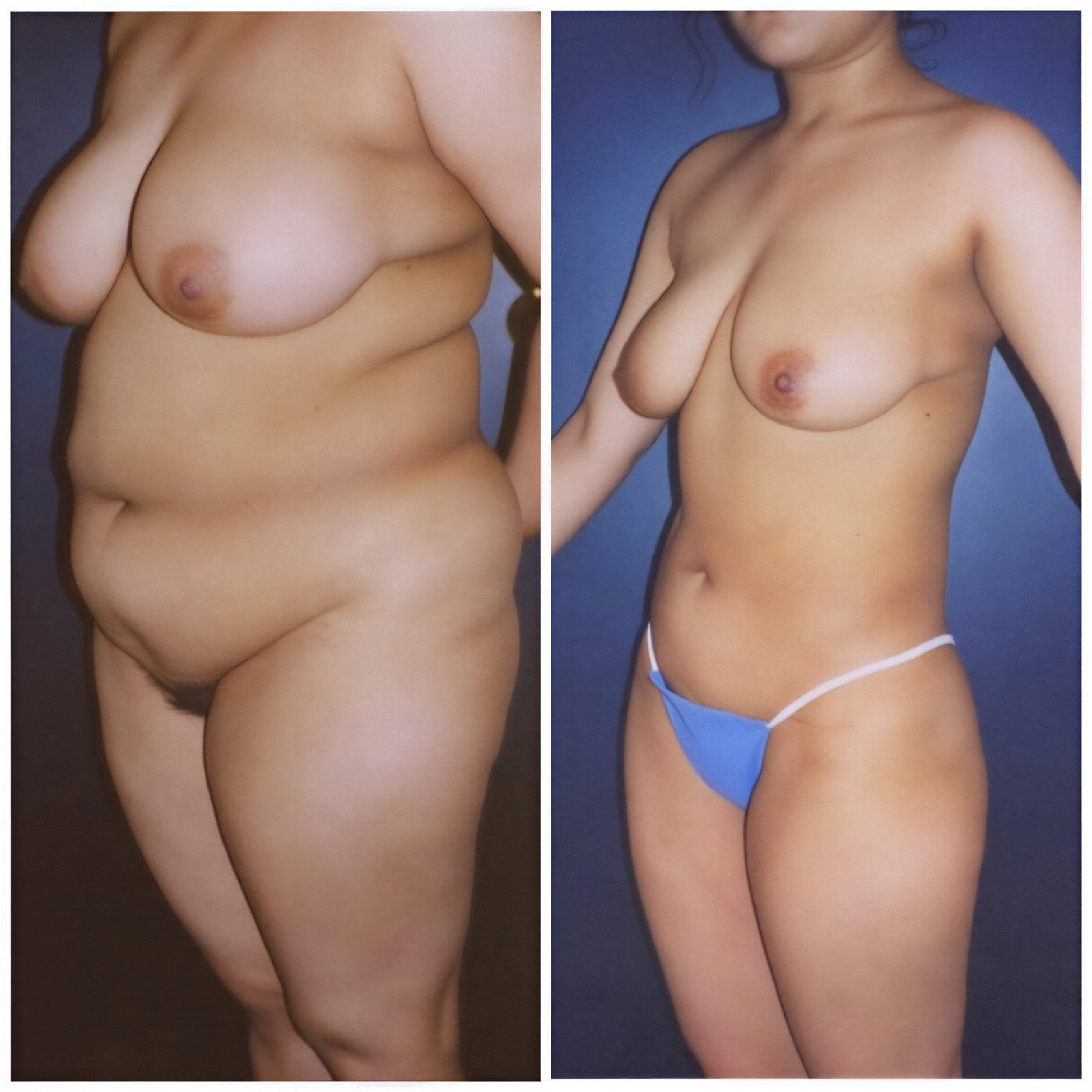نتائج شفط الدهون قبل وبعد في Dr. Arturo Muñoz Meza Plastic Surgery، نحت الجسم