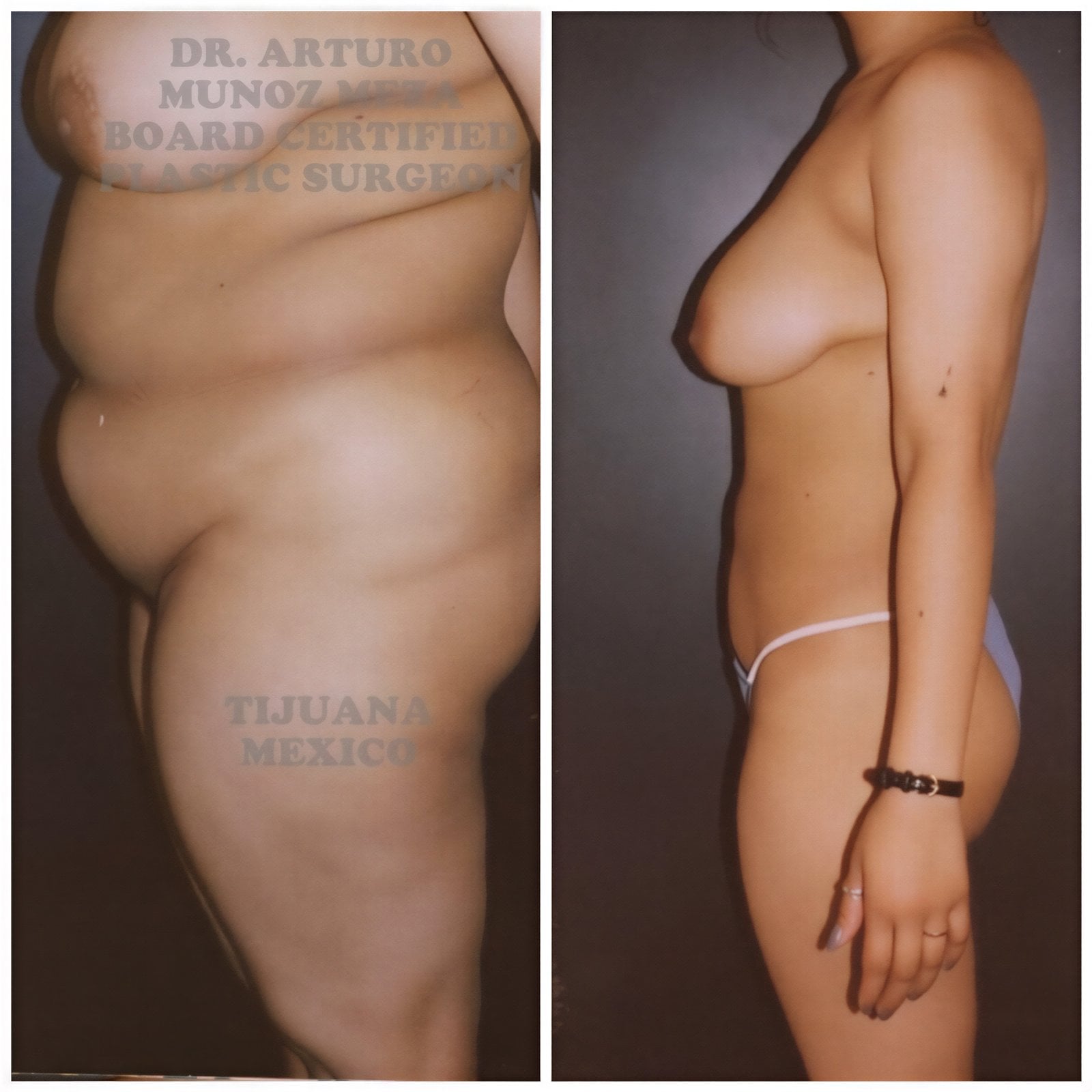 Resultados de liposucción antes y después en Dr. Arturo Muñoz Meza Plastic Surgery, contorno corporal