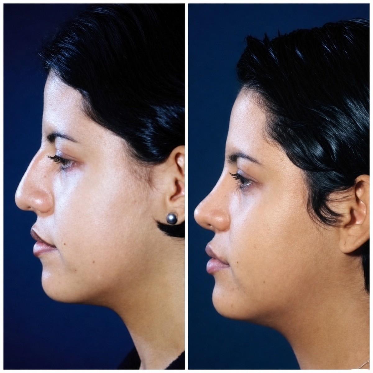 نتائج عملية تجميل الأنف قبل وبعد في عيادة Dr. Arturo Muñoz Meza Plastic Surgery، إعادة تشكيل الأنف