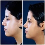 Resultados de rinoplastia antes y después en Dr. Arturo Muñoz Meza Plastic Surgery, remodelación nasal